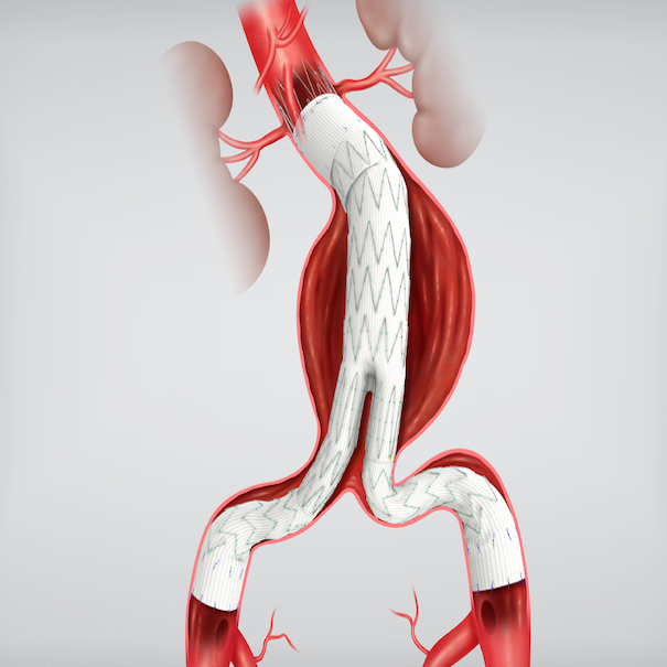 Zenith Flex Aaa Endovascular Graft Bifurcated Main Body, 1 Each