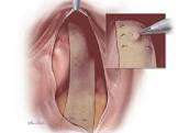 Biodesign ® Rectopexy Graft, 1 Each