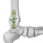 HOOK, PEDICLE, LG, TI
