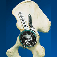 Partial Pelvis Replacement