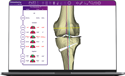 Osteotomy Guide