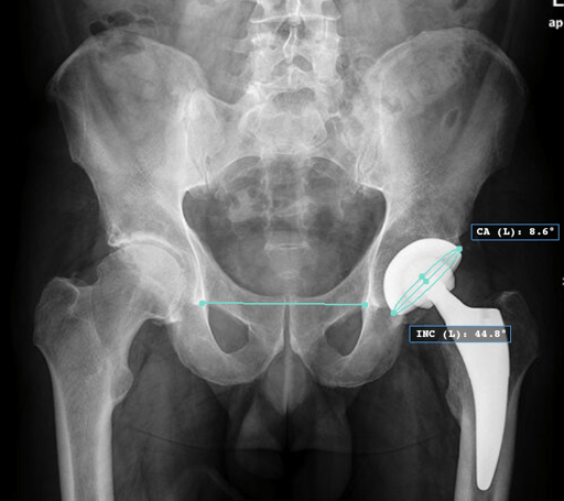 Acetabular Cup