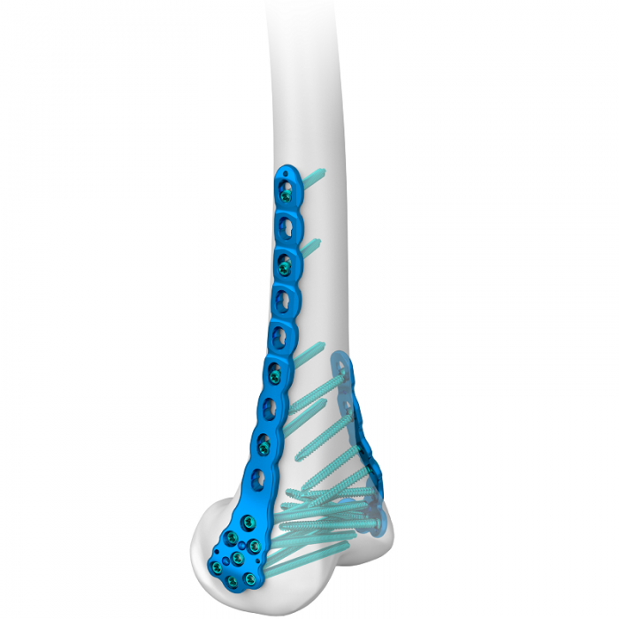 Distal Femoral Spacer