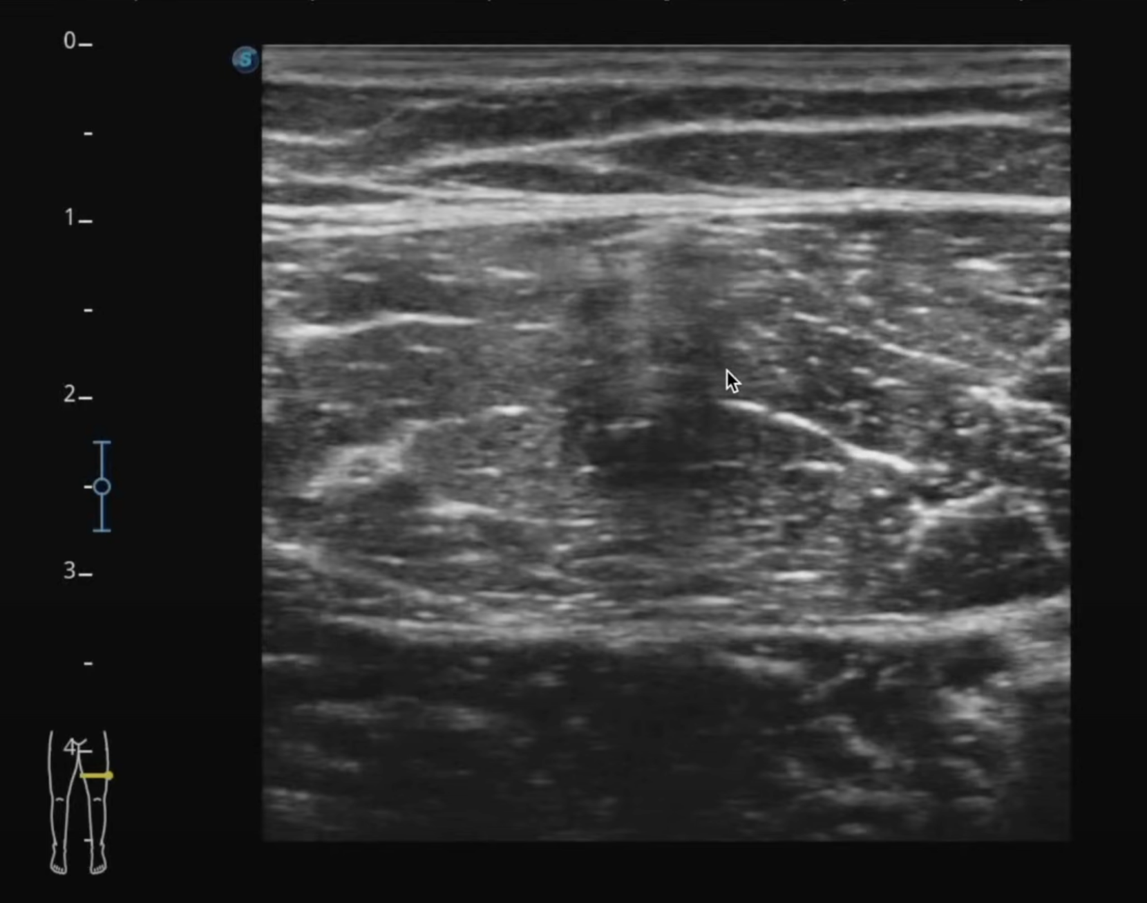 Femoral Trial Segment