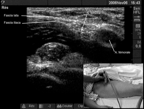 Femoral Resurfacing Block