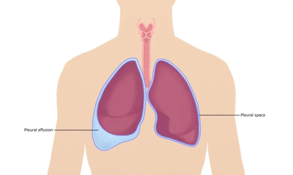 Pneumothorax Set, 1 Set