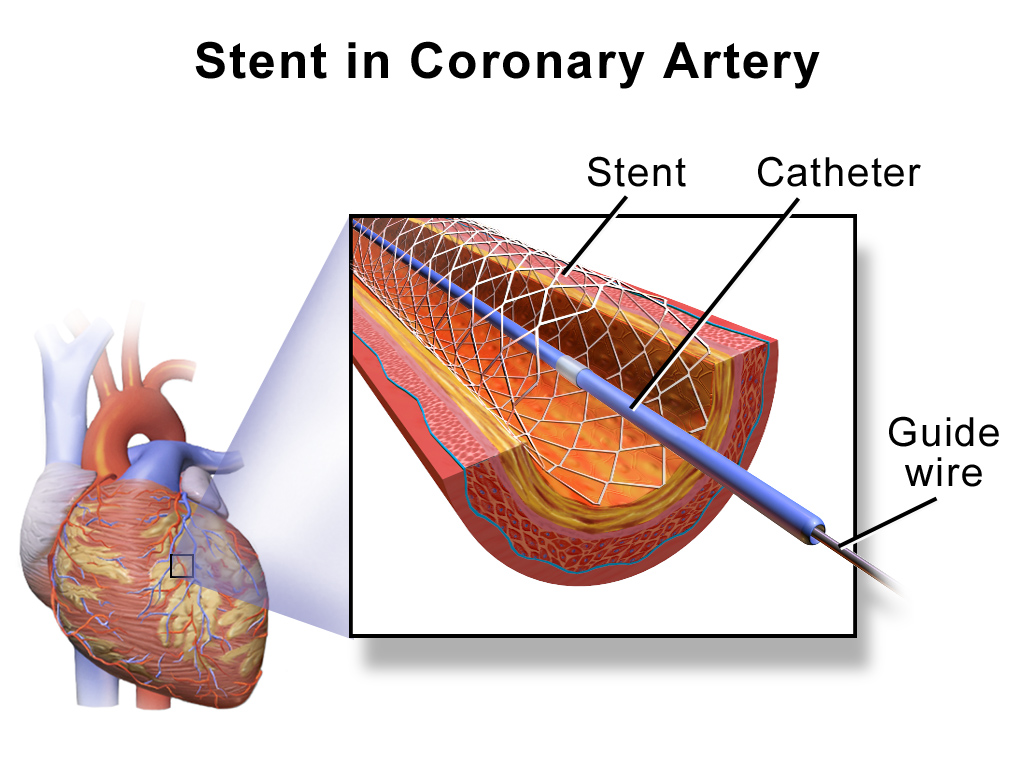 STENT PED3-027-500-40